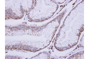 IHC-P Image Immunohistochemical analysis of paraffin-embedded human gastric cancer, using C1s, antibody at 1:500 dilution. (C1S Antikörper)