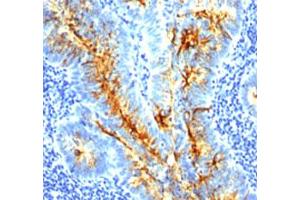 Immunohistochemical staining (Formalin-fixed paraffin-embedded sections) of human colon cancer with tag-72 monoclonal antibody, clone SPM536 . (TAG-72 Antikörper)
