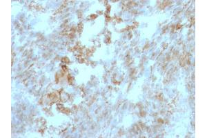 Formalin-fixed, paraffin-embedded human Colon Carcinoma stained with CD147 Mouse Monoclonal Antibody (BSG/963).