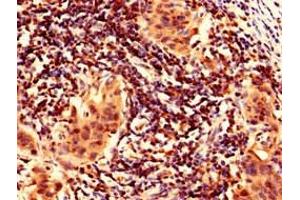 Immunohistochemistry analysis of human bladder cancer using ABIN7165446 at dilution of 1:100 (FAM171B Antikörper  (AA 59-353))