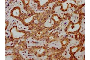 IHC image of ABIN7154988 diluted at 1:300 and staining in paraffin-embedded human liver cancer performed on a Leica BondTM system. (HBG2 Antikörper  (AA 2-147))
