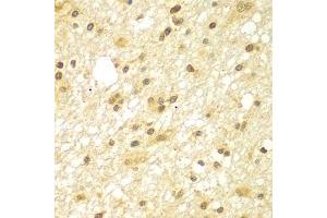 Immunohistochemistry of paraffin-embedded human brain cancer using TBL1XR1 antibody (ABIN5975754) at dilution of 1/100 (40x lens). (TBL1XR1 Antikörper)