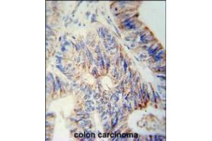 B3GNT6 Antibody immunohistochemistry analysis in formalin fixed and paraffin embedded human colon carcinoma followed by peroxidase conjugation of the secondary antibody and DAB staining. (B3GNT6 Antikörper  (AA 146-173))
