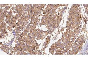 ABIN6274664 at 1/100 staining Human Melanoma tissue by IHC-P. (CYTL1 Antikörper)