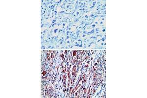 Immunohistochemical analysis of RXFP1 in paraffin-embedded formalin-fixed human stomach tumor tissue using an isotype control (top) and RXFP1 polyclonal antibody  (bottom) at 1 : 100. (RXFP1 Antikörper  (AA 694-732))