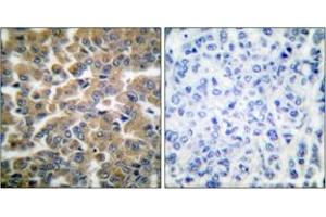 Immunohistochemistry analysis of paraffin-embedded human breast carcinoma tissue, using GR (Ab-211) Antibody. (GR (AA 181-230) Antikörper)