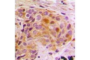 Immunohistochemical analysis of STAT5B staining in human breast cancer formalin fixed paraffin embedded tissue section. (STAT5B Antikörper)
