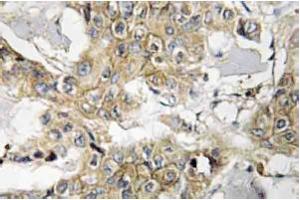 Immunohistochemistry analyzes of HER2 antibody in paraffin-embedded human breast carcinoma tissue. (ErbB2/Her2 Antikörper)