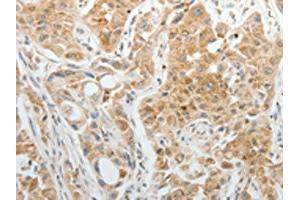 The image on the left is immunohistochemistry of paraffin-embedded Human lung cancer tissue using ABIN7192952(TTF2 Antibody) at dilution 1/5, on the right is treated with synthetic peptide. (TTF2 Antikörper)