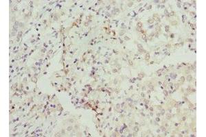 Immunohistochemistry of paraffin-embedded human lung cancer using ABIN7145588 at dilution of 1:100 (BAAT Antikörper  (AA 309-418))