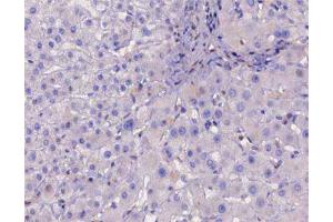 ABIN6267226 at 1/200 staining human liver cancer tissue sections by IHC-P. (IKBKB Antikörper  (pTyr188))