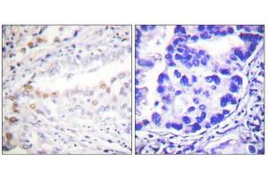 Immunohistochemistry analysis of paraffin-embedded human lung carcinoma tissue using Uba2 antibody. (UBA2 Antikörper  (C-Term))