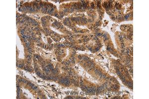 Immunohistochemistry of Human colon cancer using KCNK9 Polyclonal Antibody at dilution of 1:40 (KCNK9 Antikörper)