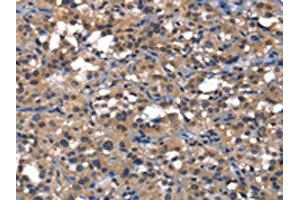 The image on the left is immunohistochemistry of paraffin-embedded Human thyroid cancer tissue using ABIN7129820(IGFBP5 Antibody) at dilution 1/25, on the right is treated with fusion protein. (IGFBP5 Antikörper)