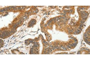 Immunohistochemistry of paraffin-embedded Human colon cancer tissue using SLC4A4 Polyclonal Antibody at dilution 1:50 (SLC4A4 Antikörper)