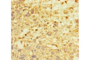 Immunohistochemistry of paraffin-embedded human melanoma using ABIN7172513 at dilution of 1:100 (E2F1 Antikörper  (AA 133-362))