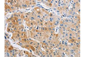 The image on the left is immunohistochemistry of paraffin-embedded Human liver cancer tissue using ABIN7128493(ARHGAP5 Antibody) at dilution 1/25, on the right is treated with fusion protein. (ARHGAP5 Antikörper)