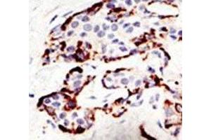 IHC analysis of FFPE human breast carcinoma tissue stained with the SUV39H2 antibody
