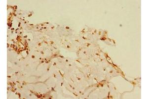 Immunohistochemistry of paraffin-embedded human breast cancer using ABIN7145551 at dilution of 1:100 (BLID Antikörper  (AA 1-108))