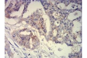 Immunohistochemical analysis of paraffin-embedded ovarian cancer tissues using CD239 mouse mAb with DAB staining.