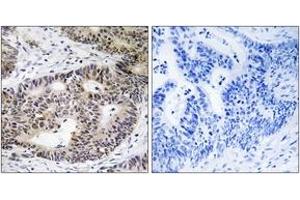 Immunohistochemistry analysis of paraffin-embedded human colon carcinoma tissue, using ZFYVE19 Antibody. (ZFYVE19 Antikörper  (AA 311-360))