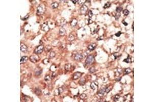 IHC analysis of FFPE human hepatocarcinoma tissue stained with the BMP5 antibody