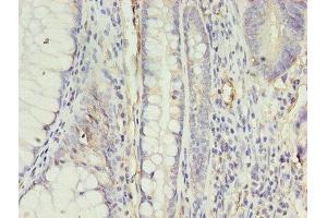 Immunohistochemistry of paraffin-embedded human colon cancer using ABIN7144394 at dilution of 1:100 (Apelin Receptor Antikörper  (AA 309-380))
