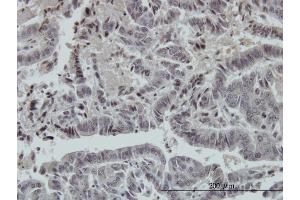 Immunoperoxidase of monoclonal antibody to FOXO3A on formalin-fixed paraffin-embedded human colon adenocarcinoma. (FOXO3 Antikörper  (AA 361-460))