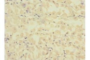 Immunohistochemistry of paraffin-embedded human gastric cancer using ABIN7152656 at dilution of 1:100
