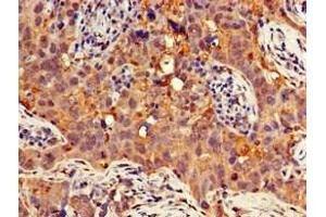 Immunohistochemistry of paraffin-embedded human pancreatic cancer using ABIN7154741 at dilution of 1:100