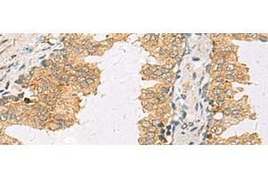 Immunohistochemistry of paraffin-embedded Human prost ate cancer tissue using SLC30A6 Polyclonal Antibody at dilution of 1:70(x200) (SLC30A6 Antikörper)