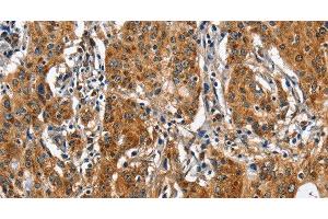 Immunohistochemistry of paraffin-embedded Human gastic cancer using BGN Polyclonal Antibody at dilution of 1:50 (Biglycan Antikörper)