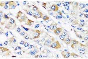 Immunohistochemistry of paraffin-embedded Human liver cancer using TSC2 Polyclonal Antibody at dilution of 1:200 (40x lens). (Tuberin Antikörper)
