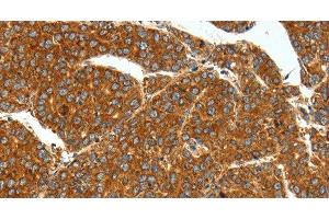 Immunohistochemistry of paraffin-embedded Human liver cancer using SSTR1 Polyclonal Antibody at dilution of 1:40 (SSTR1 Antikörper)
