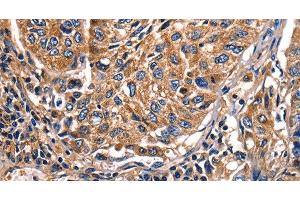 Immunohistochemistry of paraffin-embedded Human lung cancer tissue using Galectin 8 Polyclonal Antibody at dilution 1:50 (LGALS8 Antikörper)