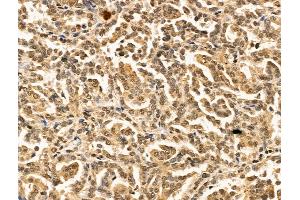 ABIN7094829 and ABIN7098880 at 1/100 staining Human kidney cancer by IHC-P.