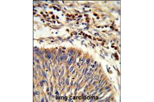 Formalin-fixed and paraffin-embedded human lung carcinoma reacted with HSPA6 Antibody , which was peroxidase-conjugated to the secondary antibody, followed by DAB staining. (HSPA6 Antikörper  (C-Term))