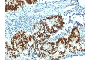 Formalin-fixed, paraffin-embedded human Colon Carcinoma stained with p53 Mouse Monoclonal Antibody (PAb1801). (p53 Antikörper)