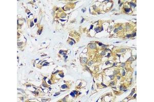 Immunohistochemistry of paraffin-embedded Human breast cancer using CCDC124 Polyclonal Antibody at dilution of 1:100 (40x lens). (CCDC124 Antikörper)