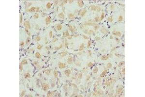 Immunohistochemistry of paraffin-embedded human gastric cancer using ABIN7168446 at dilution of 1:100 (ROBO3 Antikörper  (AA 1237-1386))