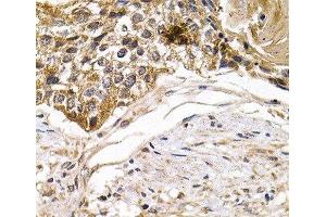 Immunohistochemistry of paraffin-embedded Human breast cancer using ARRB2 Polyclonal Antibody at dilution of 1:200 (40x lens). (Arrestin 3 Antikörper)
