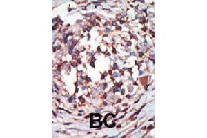 Formalin-fixed and paraffin-embedded human cancer tissue reacted with PRKCB polyclonal antibody  , which was peroxidase-conjugated to the secondary antibody, followed by AEC staining . (PKC beta Antikörper  (C-Term))