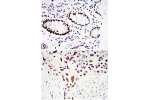 Immunohistochemical analysis of paraffin-embedded human colon cancer tissues (upper) and lung cancer tissues (bottom) using KLF4 monoclonal antibody, clone 1E6  with DAB staining.