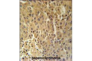DHB13 Antibody immunohistochemistry analysis in formalin fixed and paraffin embedded human hepatocarcinoma followed by peroxidase conjugation of the secondary antibody and DAB staining. (HSD17B13 Antikörper  (N-Term))