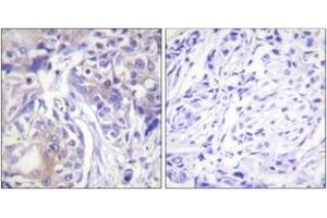 Immunohistochemistry analysis of paraffin-embedded human breast carcinoma tissue, using ADD1 (Ab-445) Antibody. (alpha Adducin Antikörper  (AA 411-460))
