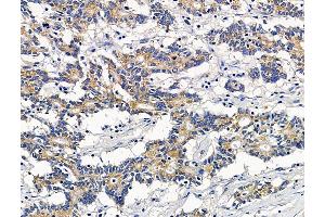 ABIN7096488 and ABIN7100552 at 1/100 staining human colorectal cancer by IHC-P. (SNTG2 Antikörper)