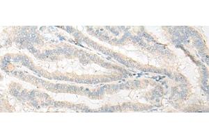 Immunohistochemistry of paraffin-embedded Human thyroid cancer tissue using DNASE1L1 Polyclonal Antibody at dilution of 1:25(x200) (DNASEX Antikörper)