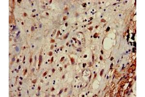Immunohistochemistry of paraffin-embedded human lung cancer using ABIN7144346 at dilution of 1:100