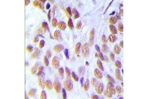 Immunohistochemical analysis of HMGB1 staining in human breast cancer formalin fixed paraffin embedded tissue section. (HMGB1 Antikörper)