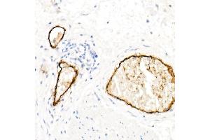 Immunohistochemistry of paraffin-embedded Human esophageal cancer using von Willebrand factor (VWF) antibody (ABIN7271339) at dilution of 1:800 (40x lens). (VWF Antikörper)